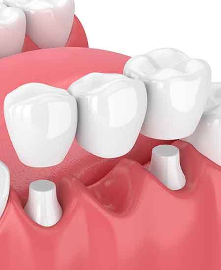  learn more about the benefits of dental bridges
