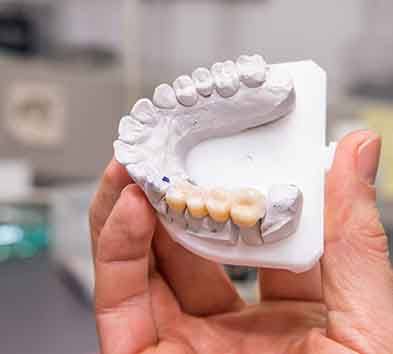 there are two main types of dental bridges