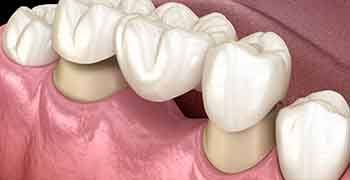 traditional dental bridges fit over two abutment teeth like caps