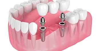 Implant bridges permanently connect to your jaw with dental implants
