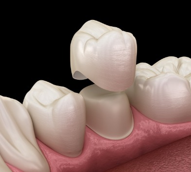 Animated smile during dental crown placement