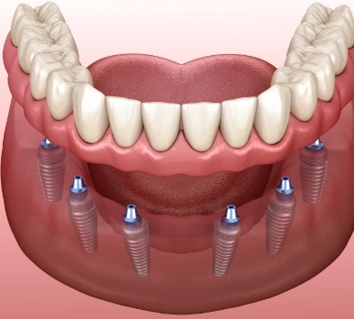 Animated smile during full mouth reconstruction
