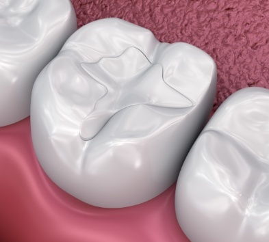 Animated smile with dental sealants