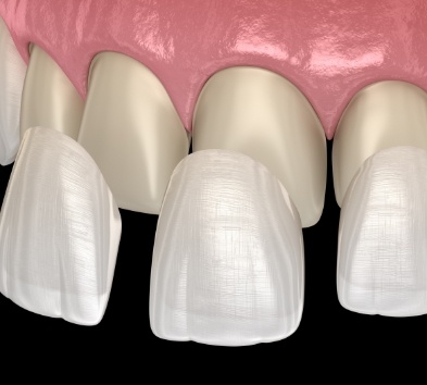 Animated smile during dental bonding treatment