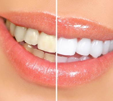 Smile before and after teeth whitening