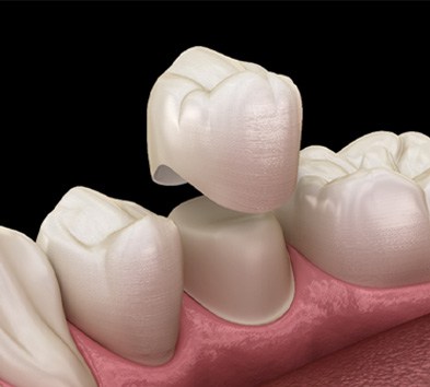 3D render of a dental crown