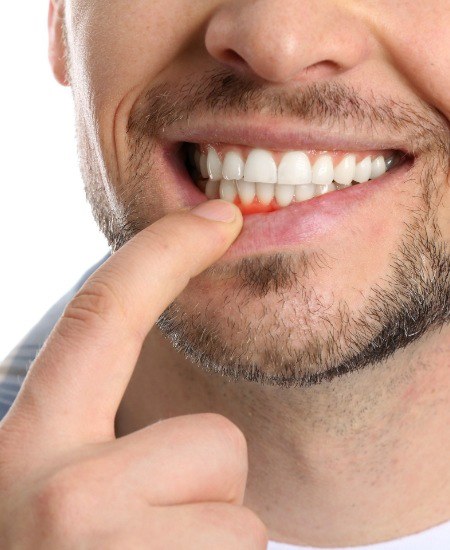 Man pointing to red gums and needing gum disease treatment in Indianapolis