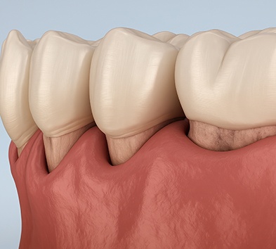 Digital image of gum recession