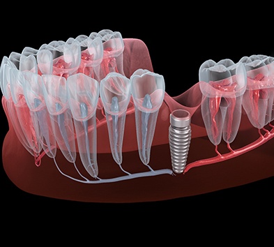 Illustration of a failed dental implant in Indianapolis, IN