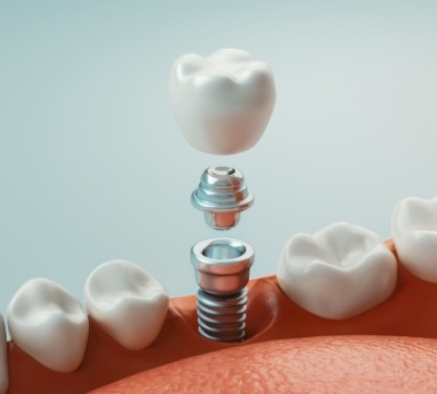 Animated smile during dental implant placement