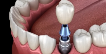 Animated smile during dental implant supported dental crown placement