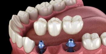 Animated smile during dental implant supported fixed bridge placement