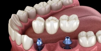 Animated smile during dental implant supported fixed bridge placement