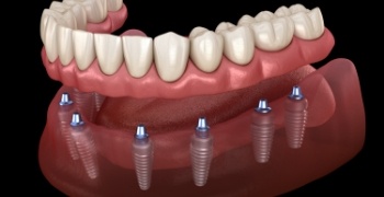 Animated smile during dental implant supported denture placement