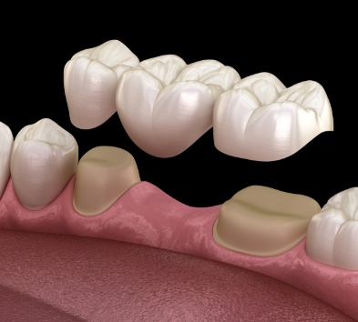 Animated smile during dental bridge placement