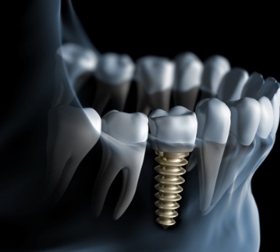 Animated smile after dental implant tooth replacement