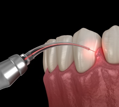 Animated smile during soft tissue laser dentistry treatment