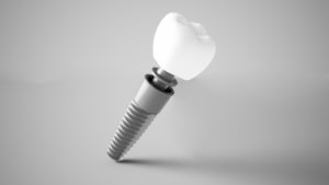 Single unit dental implant