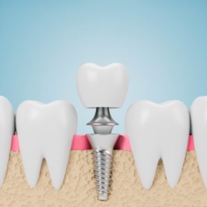 3D illustration of dental implant 