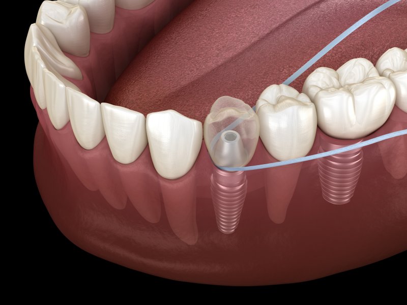 Render of using dental floss to clean dental implants