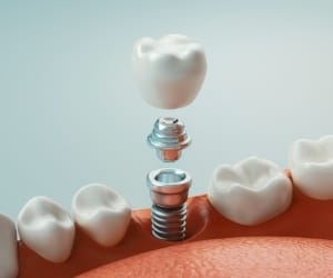 Image of a single dental implant