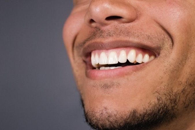 person with veneers smiling 