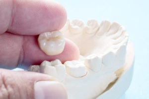 All-ceramic dental crown next to mold of a lower arch