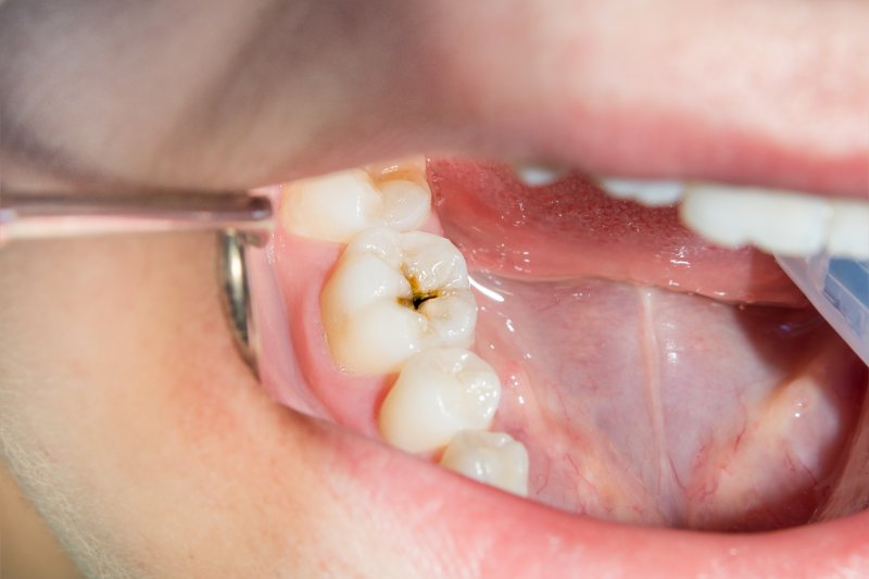 A closeup of a smile with tooth decay