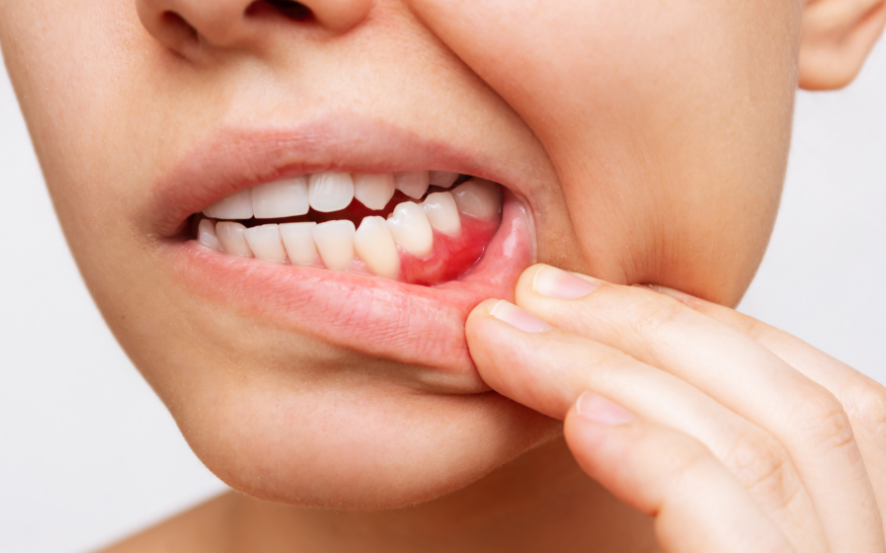woman showing inflammed gums